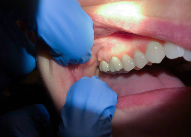 Best Root Canal Emergency Dentist  in Buena Vista, MI